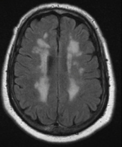 Vascular Cognitive Impairment, Part 2 - Practical Neurology