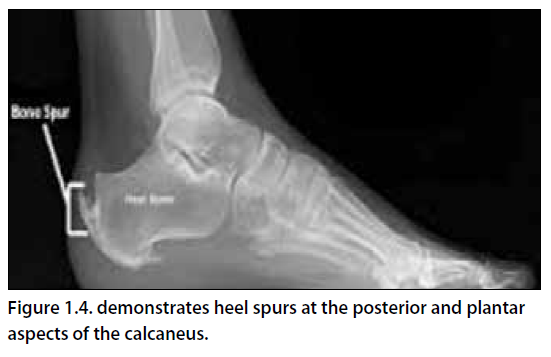 Heel Pain - Footsteps: Christopher Formanek, DPM
