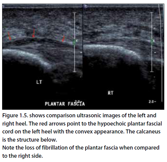 Haglunds/Heel Spur/Achilles Tendinitis - Christopher Miller