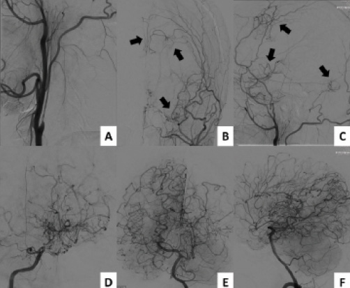 Moyamoya: An Update for the Practicing Neurologist - Practical Neurology