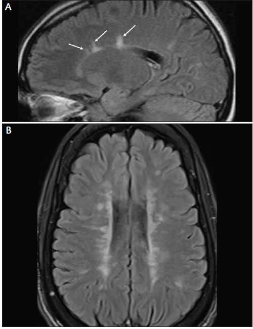 ms mri brain scan results