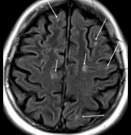 MS Brain Lesions and Their Effects