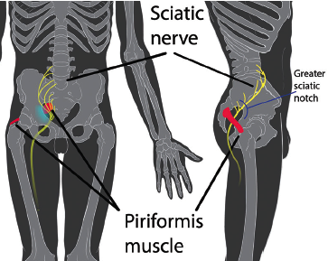 Piriformis Syndrome and Sciatica Nerve - Complete Orthopedics