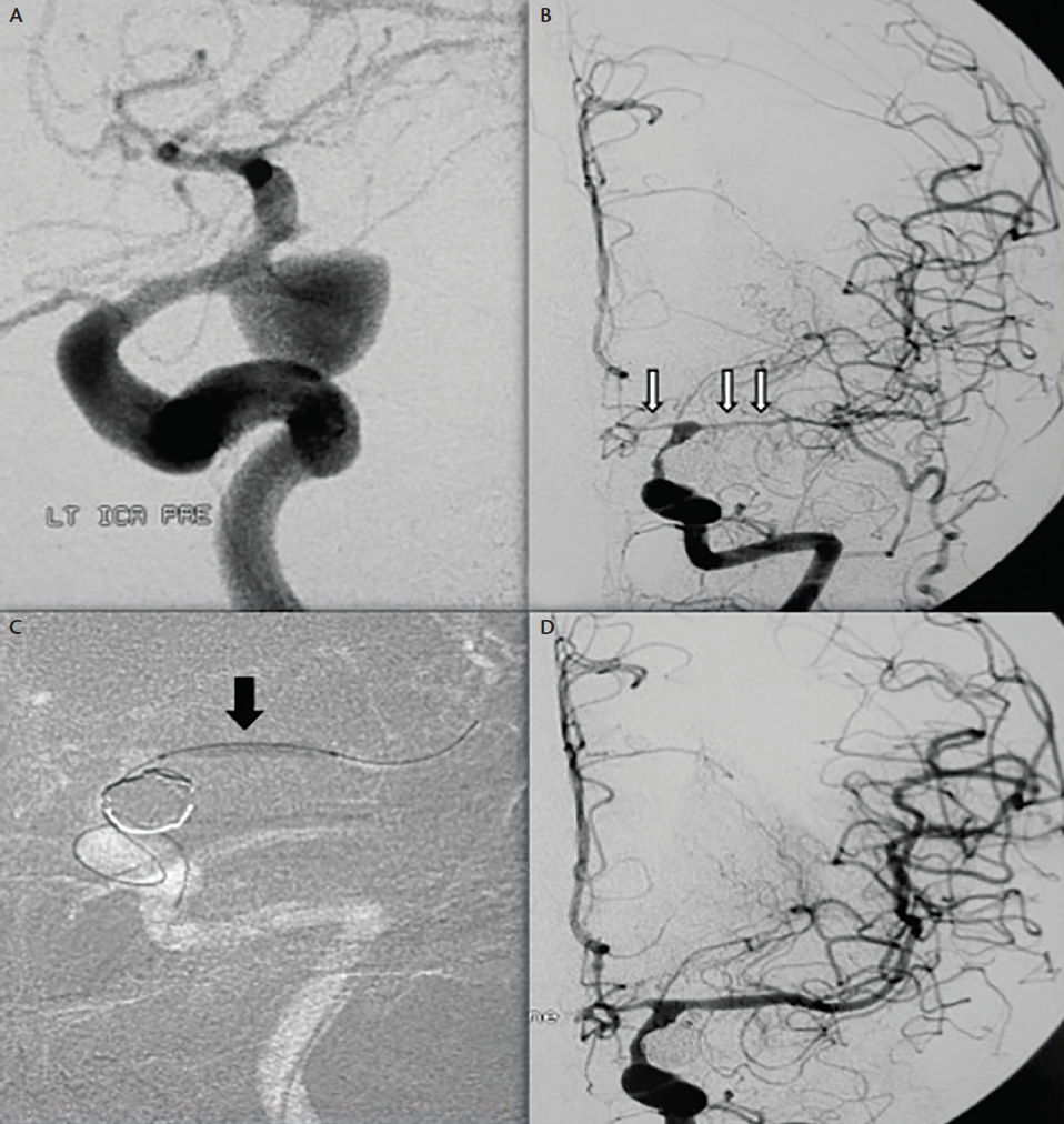 Subarachnoid Hemorrhage, Vasospasm, and Delayed Cerebral Ischemia -  Practical Neurology