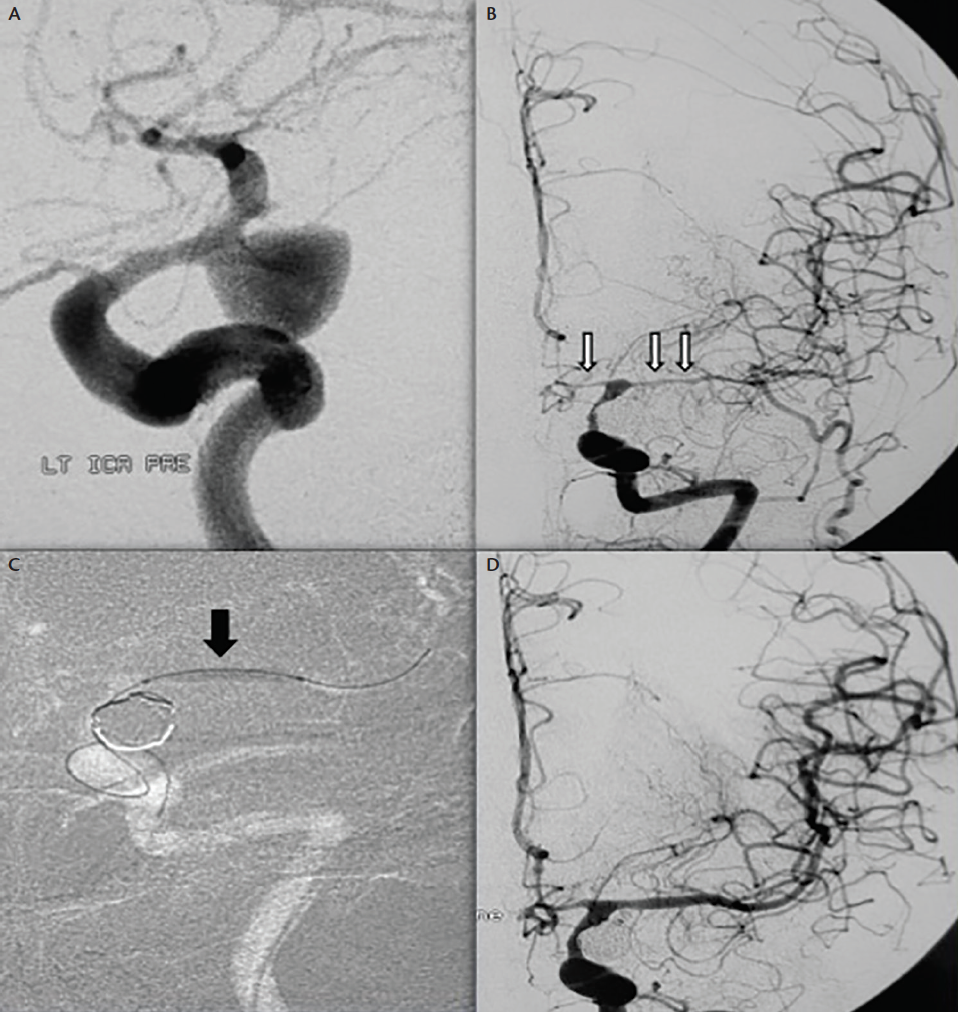 Subarachnoid Hemorrhage (SAH): Symptoms & Treatment