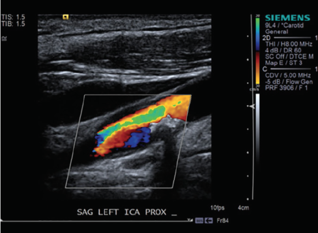 Arterial Duplex Scan Showed A Severe Internal Carotid - vrogue.co