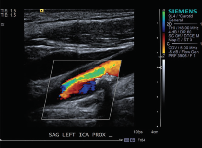 Define Asymptomatic Carotid Stenosis - mapasgmaes