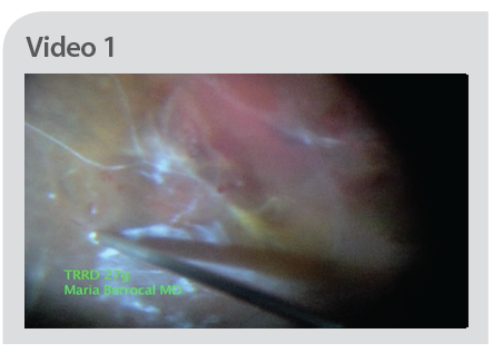 健康・医学 Small-Gauge Vitrectomy for Diabetic Comparison of 27-Gauge to 25-Gauge Vitrectomy in Patients