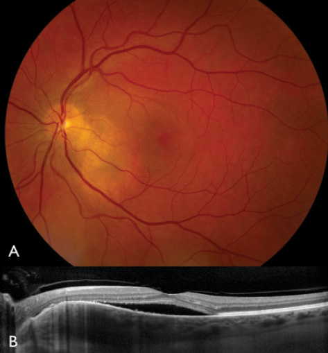 choroidal nevus with red free filter