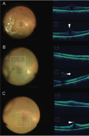 Image-Assisted Vitreoretinal Surgery: The Emergence Of Intraoperative ...