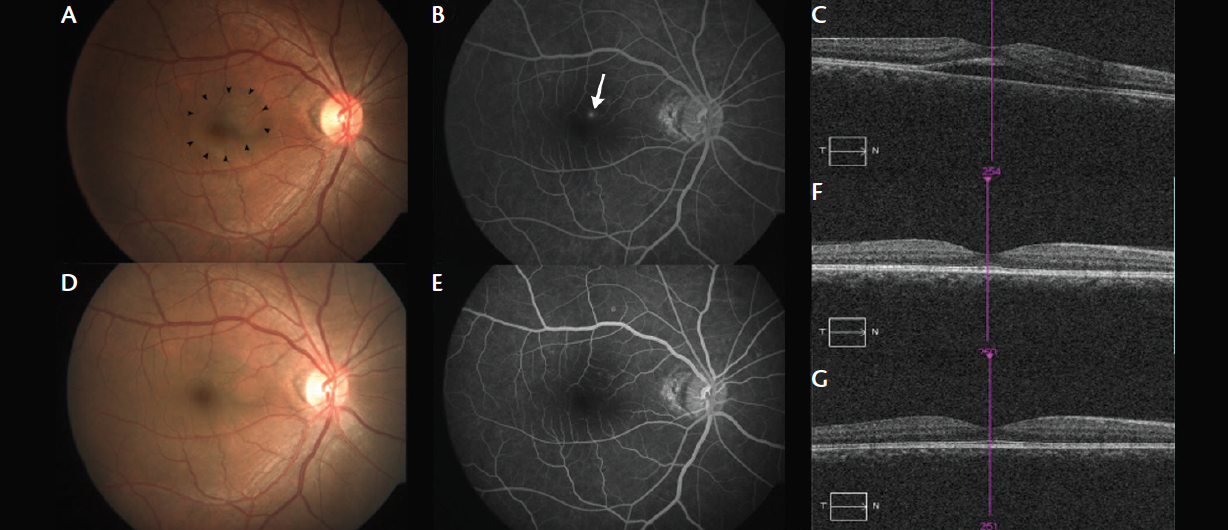 Navigated Microsecond Laser for Recurrent CSCR With Subfoveal Leaks ...