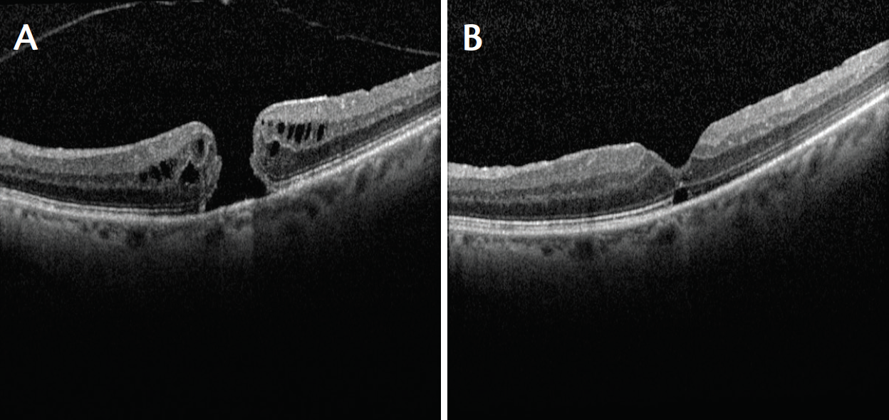 macular hole repair using an ilm patch retina today