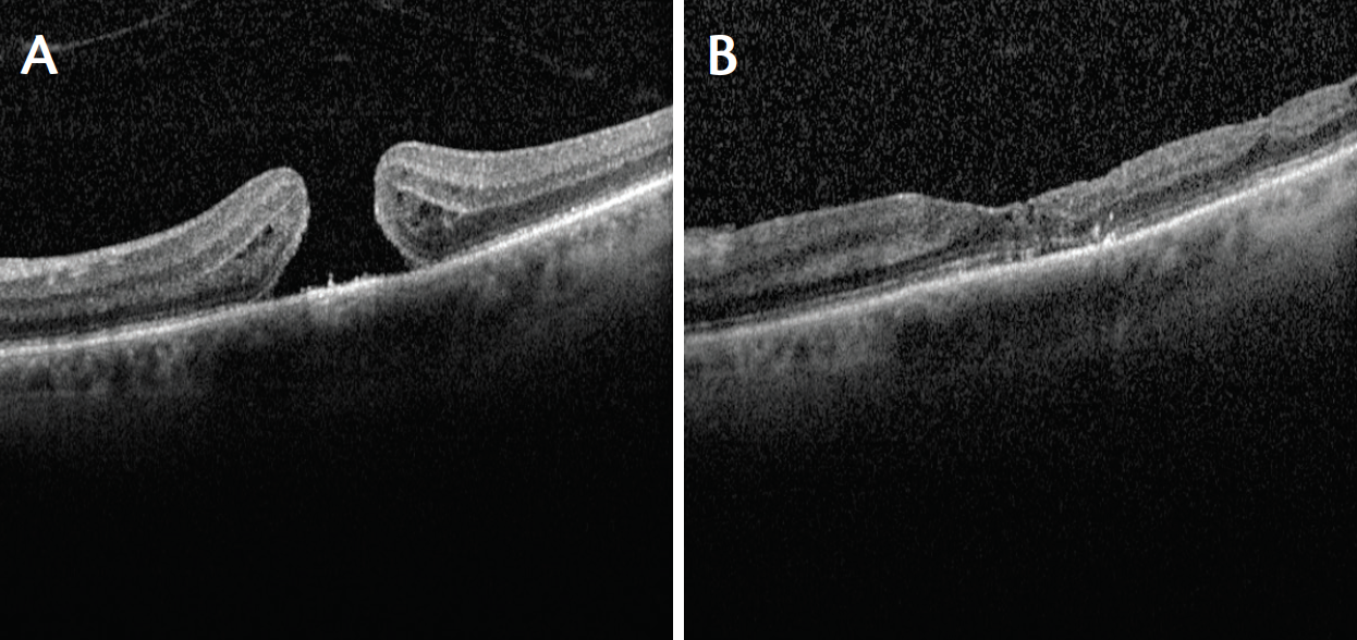 macular hole repair using an ilm patch retina today