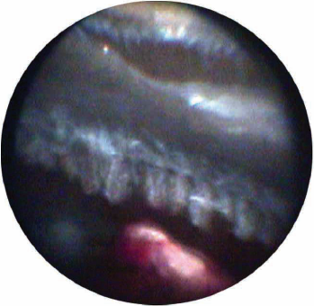 Endoscopy: An Overlooked Tool in the Management of Ocular Trauma ...