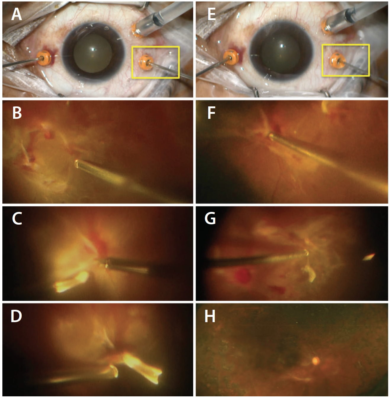 Hybrid 27-Gauge Vitrectomy - Retina Today