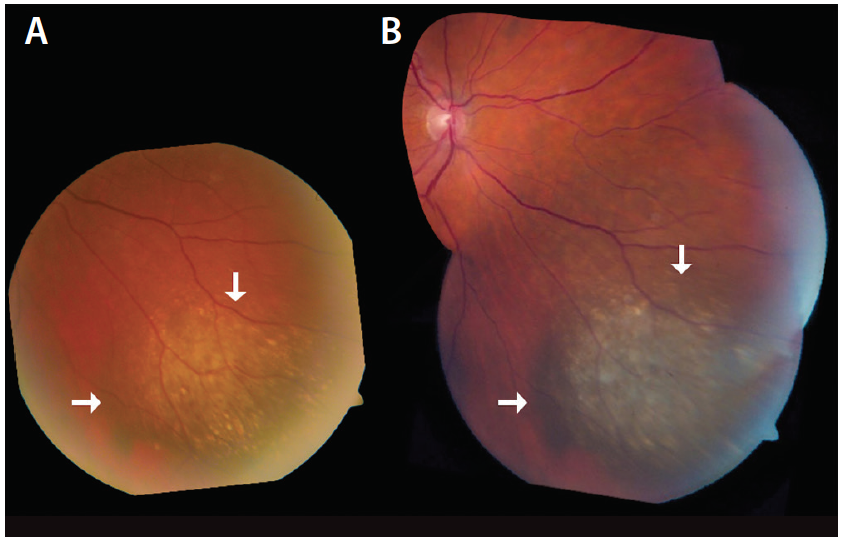 Choroidal Nevus With Lipofuscin