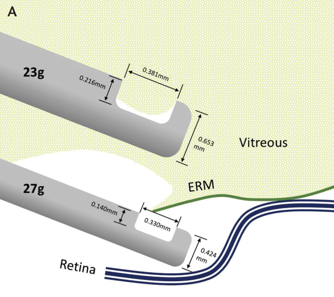 Vitreoretinal Eye Surgery Broward & Miami-Dade, FL | Aran