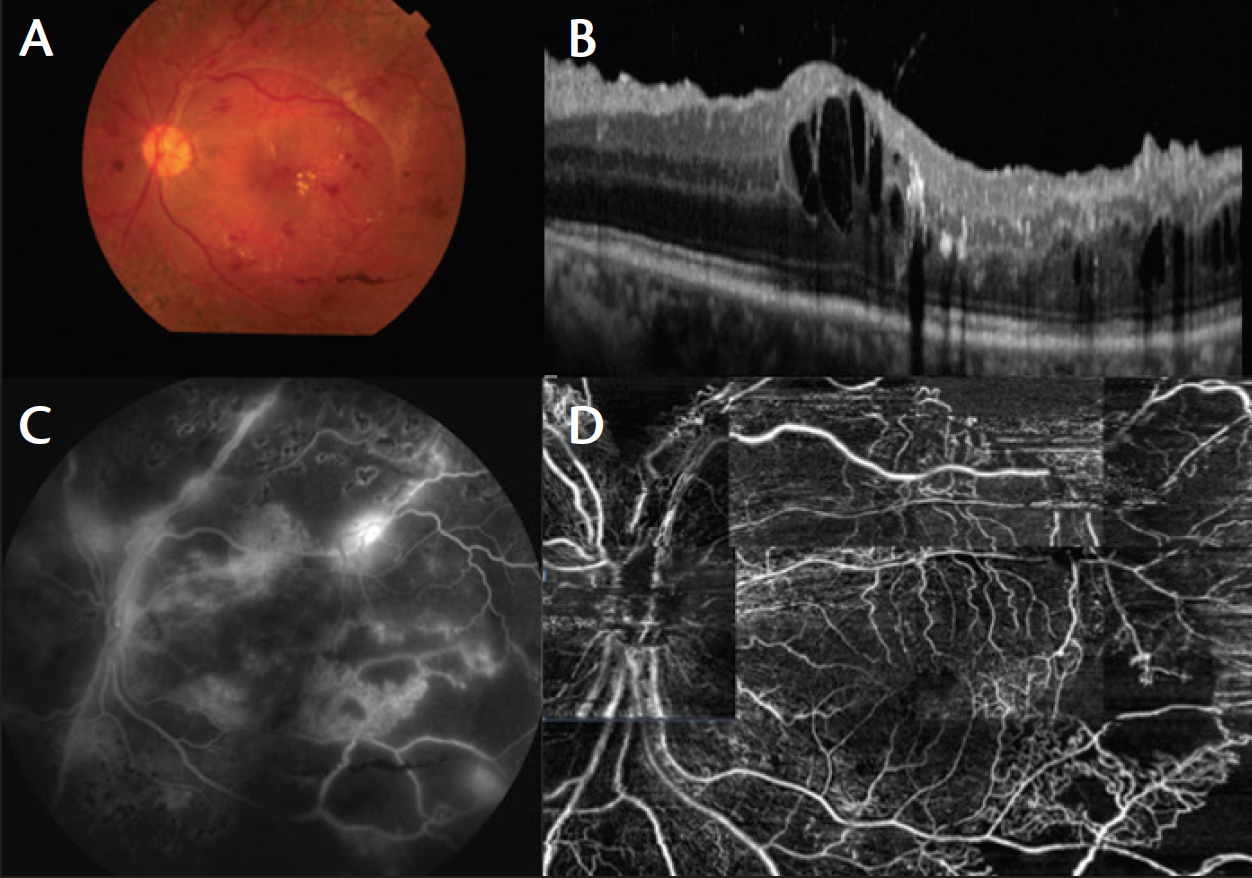 Panoramic Imaging With OCTA - Retina Today