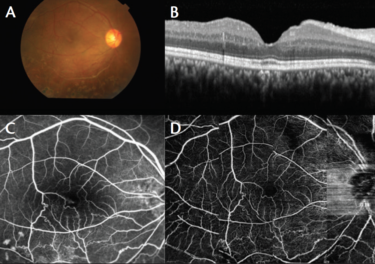 Panoramic Imaging With OCTA - Retina Today