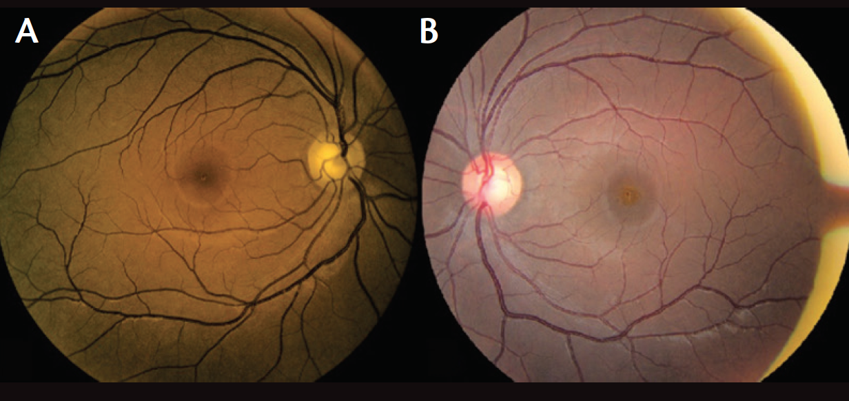 Макулопатия глаза. Солнечная ретинопатия. Солнечная ретинопатия ЭТРН. Солнечная макулопатия.
