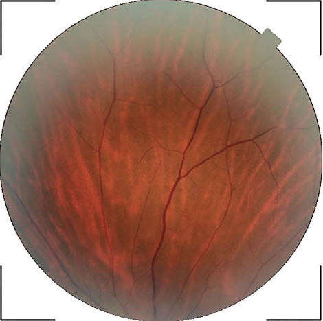 Ophthalmologic Diagnosis And Follow-Up In Von Hippel-Lindau Disease ...