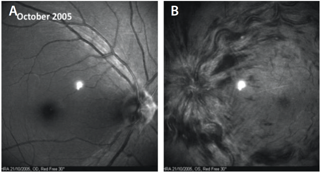 Normal Retina vs. Papilledema - Trial Exhibits Inc.