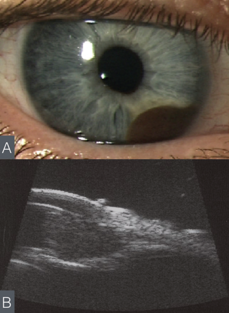 Updated Classification for Primary Iris Melanoma - Retina Today
