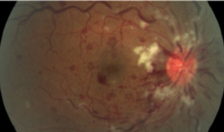 Normal Retina vs. Papilledema - Trial Exhibits Inc.