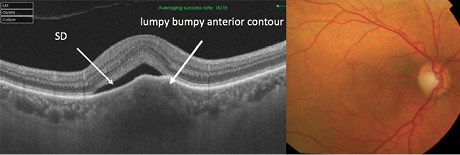 SS-Imaging of Choroidal Tumors - Retina Today