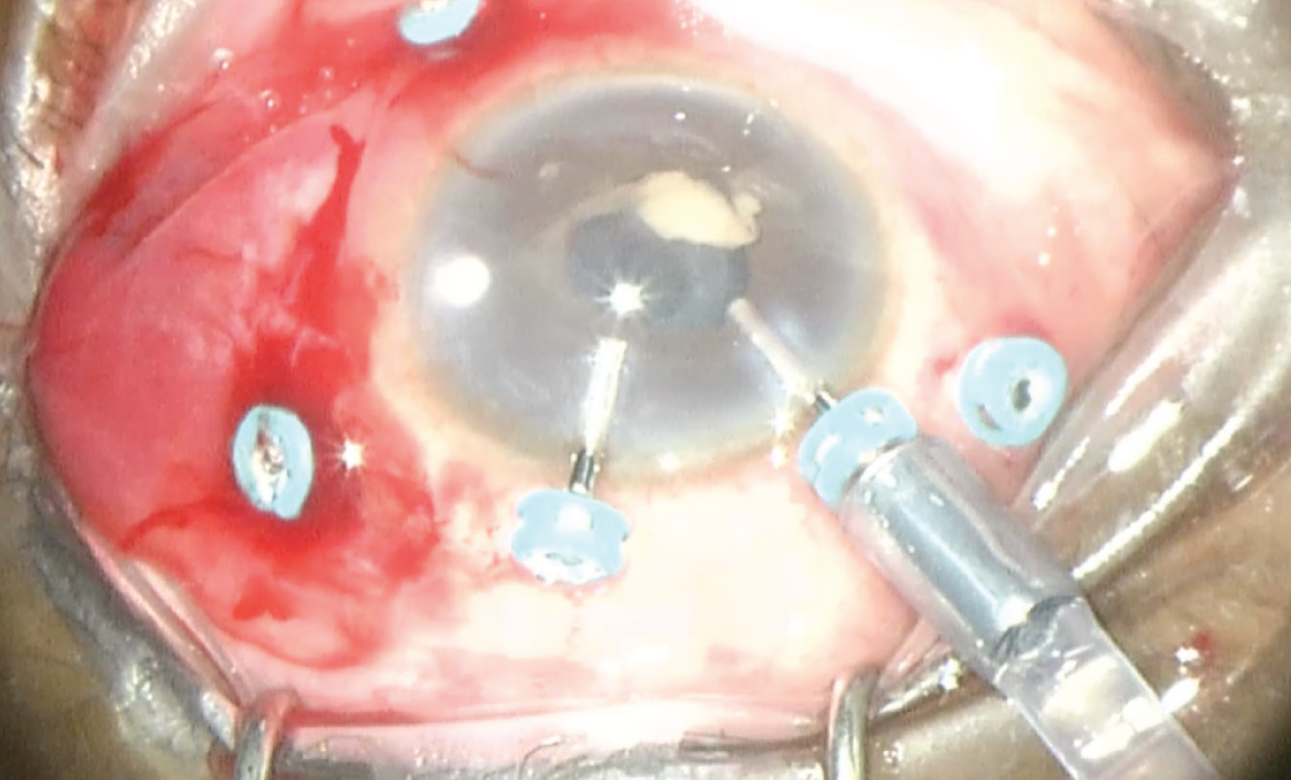 Surgical Techniques for Managing Infectious Endophthalmitis