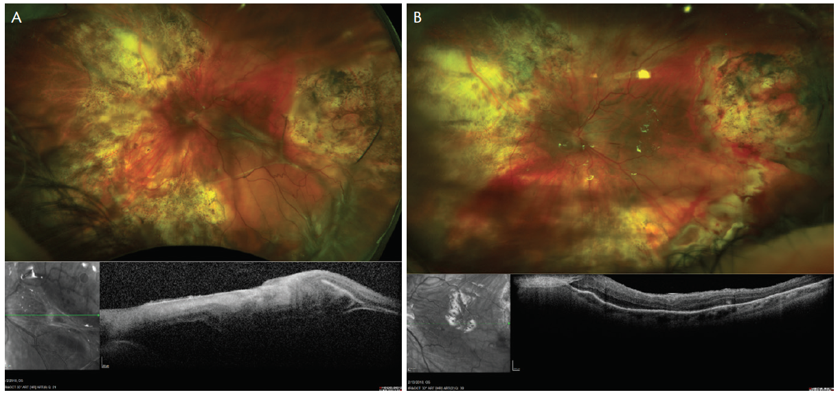 Top Five Pointers for Working With Silicone Oil Retina Today
