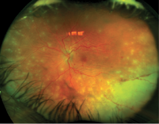 Getting a Good Look at Uveitis With Multimodal Imaging Retina Today