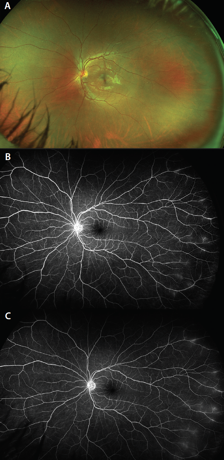 When Ultra-Widefield Retinal Imaging Is Most Useful - Retina Today