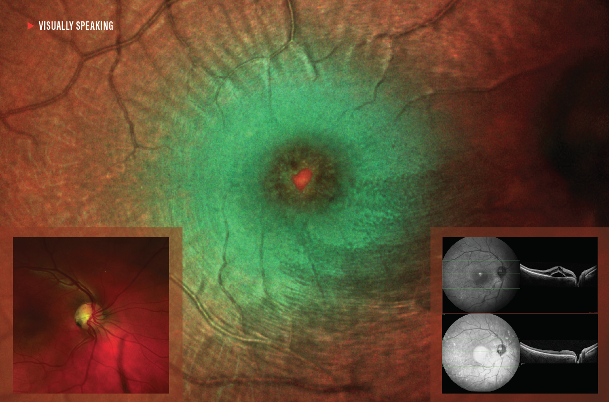 Optic Disc Pit Maculopathy - Retina Today