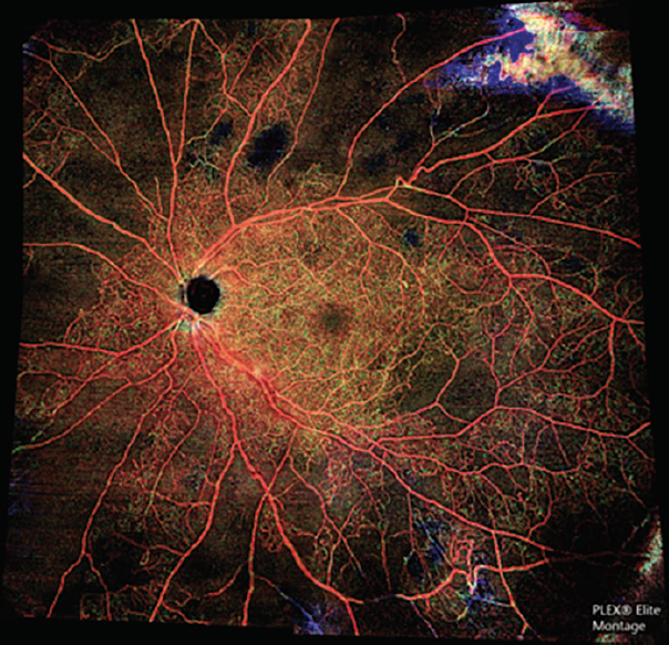 Using OCT Angiography To Diagnose High-Risk Diabetic Retinopathy ...