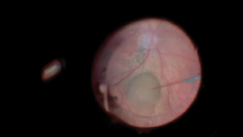 Autologous Retinal Transplant for a Refractory Macular Hole - Retina Today