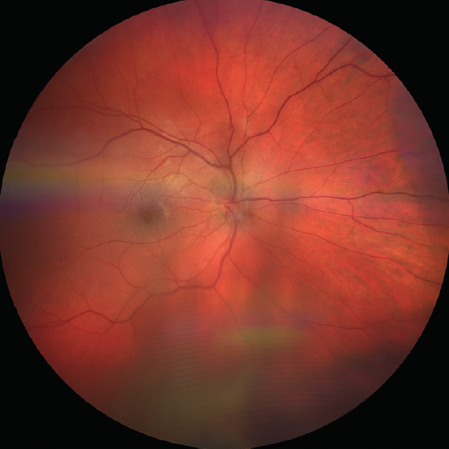 retinal flame hemorrhage
